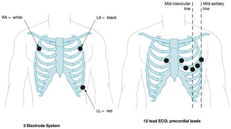3 Lead Left And 12 Lead Right Ecg Electrode Placement