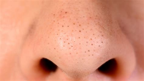 The Truth About Comedonal Acne