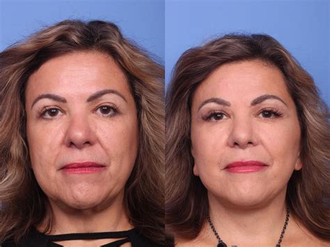 Facelift Before And After Pictures Case 149 Scottsdale Az Hobgood Facial Plastic Surgery