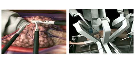 Robotic Surgery The Thyroid Head Neck Surgery Centre