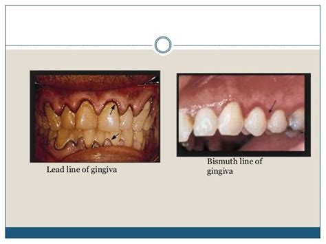 Pigmented lesions of oral cavity