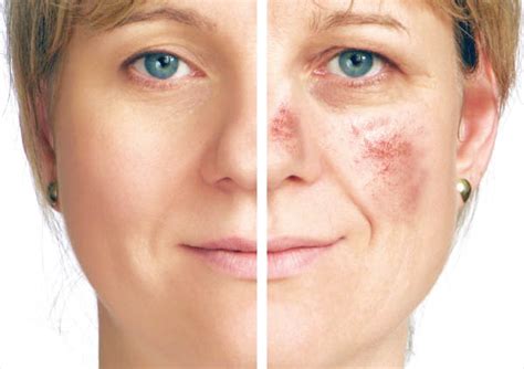 Ivermectin tablets are approved by the fda to treat people with intestinal strongyloidiasis and onchocerciasis, two conditions caused by parasitic worms. Rosacea ursache | Rosacea. 2020-05-11