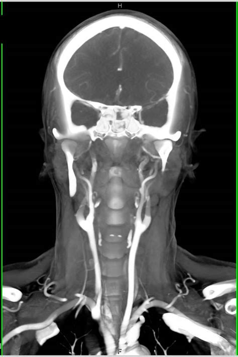 Normal Cta Of The Head And Neck Neuro Case Studies Ctisus Ct Scanning