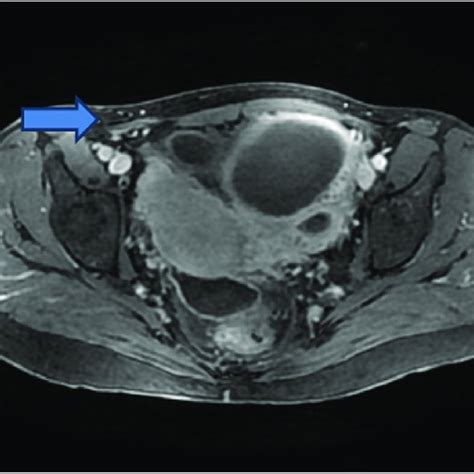 Laparoscopy Showing A Tubo Ovarian Abscess Adherent To The Sigmoid