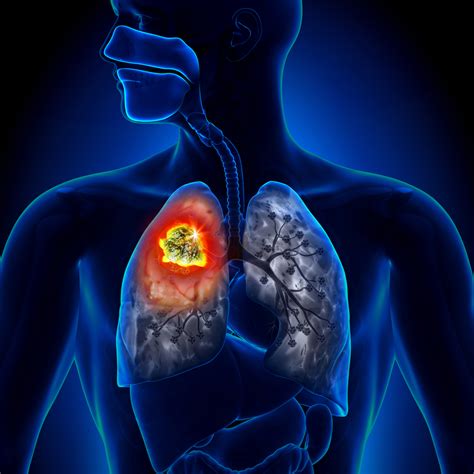 Lung Disease Disability Benefits The New Jersey Disability Attorney