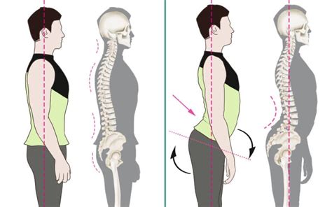 Lordosis Archives Spine Info