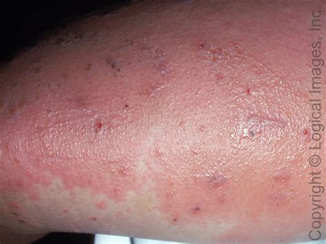 17 Year Old Male With Quickly Spreading Rash Journal Of Urgent Care