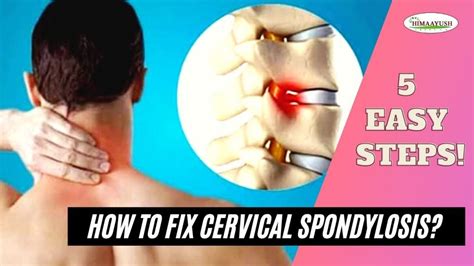 Cervical Spondylosis Relief With 5 Easy Exercise And Home Remedies