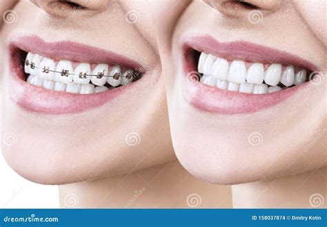 Beautiful Smile With Perfect Teeth Before And After Braces Stock Photo