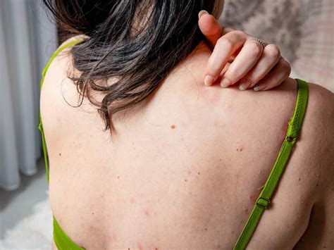 Papular Urticaria Symptoms Causes And Treatment