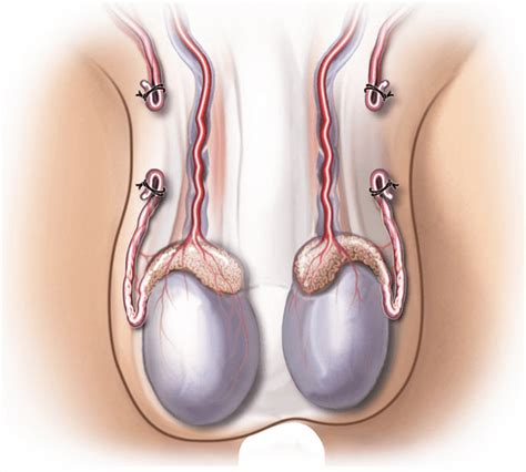 Impact Of Reversal Of Vasectomy In Sperm Telegraph