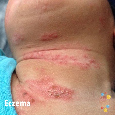 Eczema Skin Deep