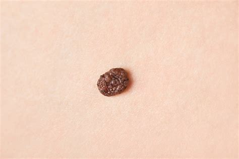 Melanoma Skin Cancer Mole Stock Photo Download Image Now Istock