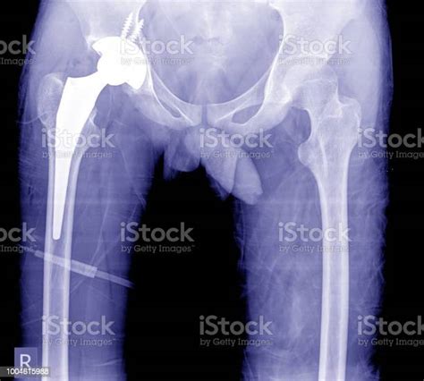 Xray Image Post Operation Total Hip Replacementtotal Hip Arthroplasty