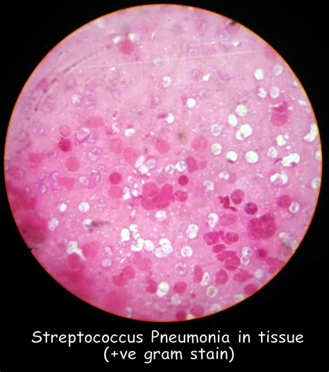 Streptococcus pneumoniae gram stain of sputum as shown above picture. Streptococcus Pneumonia in tissue (+ve gram stain) | Flickr