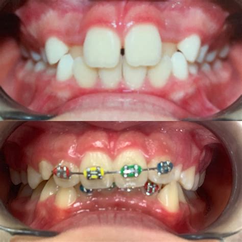 Invisalign Avant Et Apr S Orthodontie Firouz West Los Angeles