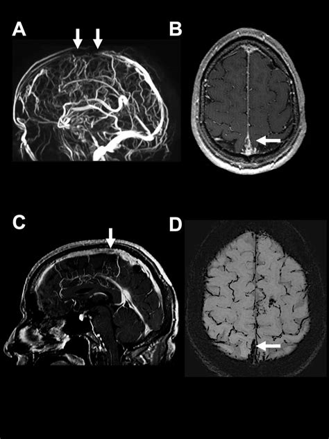 Cavernous Sinus Thrombosis Mrv