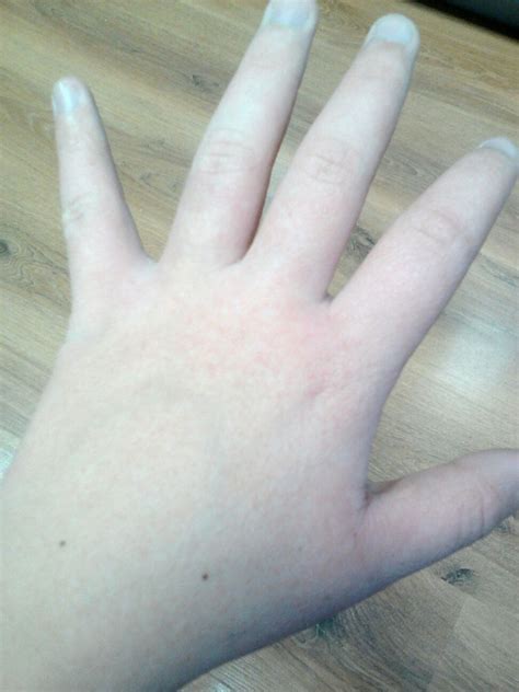 Сыпь на руках покраснение рук Вопрос дерматологу 03 Онлайн
