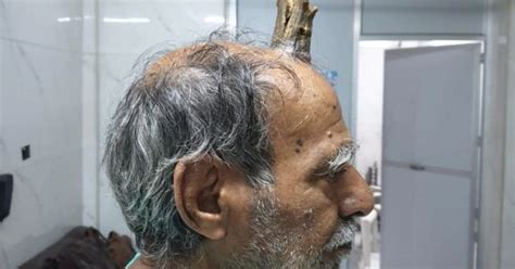 74 Yo Madhya Pradesh Man Grows A Devils Horn On His Head After Injury