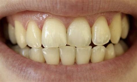 Stains On Teeth Causes Treatment And How To Prevent What To Wear