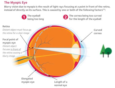 Myopia Eye Diagram