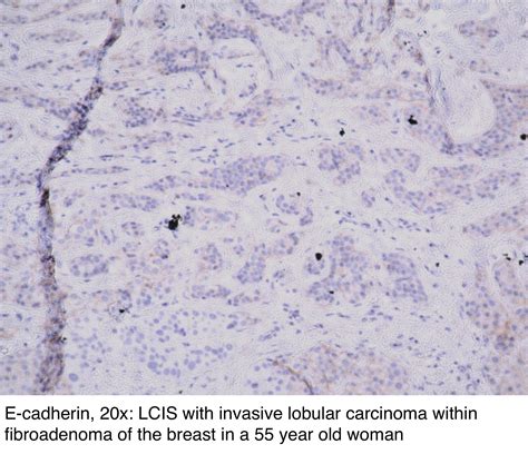 Pathology Outlines Classic Infiltrating Lobular Carcinoma