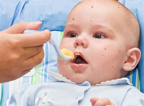 Food Allergy Symptoms In Babies And Children Parenting How
