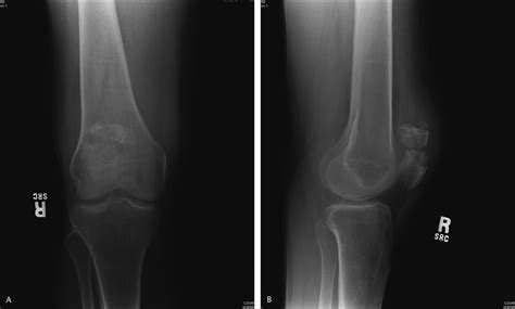Case Reports Pathologic Fracture Of The Patella From A Gout