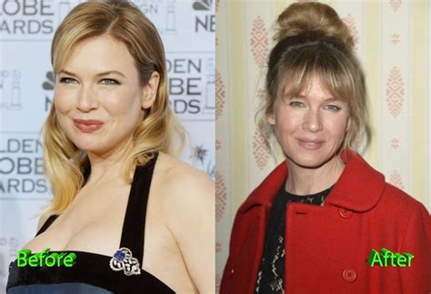 Renee Zellweger Before And After Cosmetic Surgery Celebrity Plastic