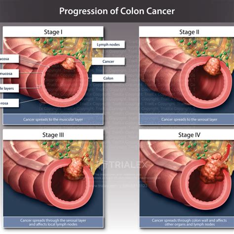 Progression Of Colon Cancer Trialexhibits Inc