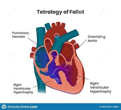Tetralogy Of Fallot Composition Of The Heart Defects Vector