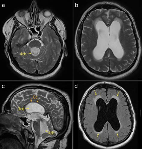 Obstructive Hydrocephalus Radiology At St Vincents University Hospital