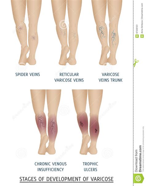 Types Of Varicose Veins In Women Stages Of Development Of Varicose