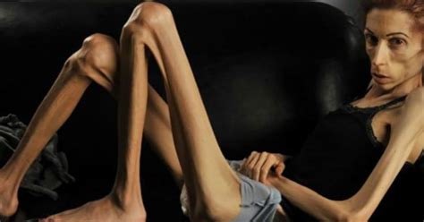 Comó Detectar La Anorexia O La Bulimia