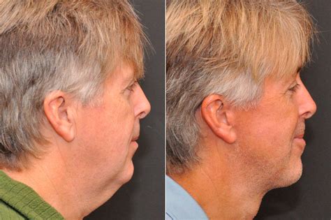 Male Plastic Surgery Photos Cincinnati Oh Patient 8092