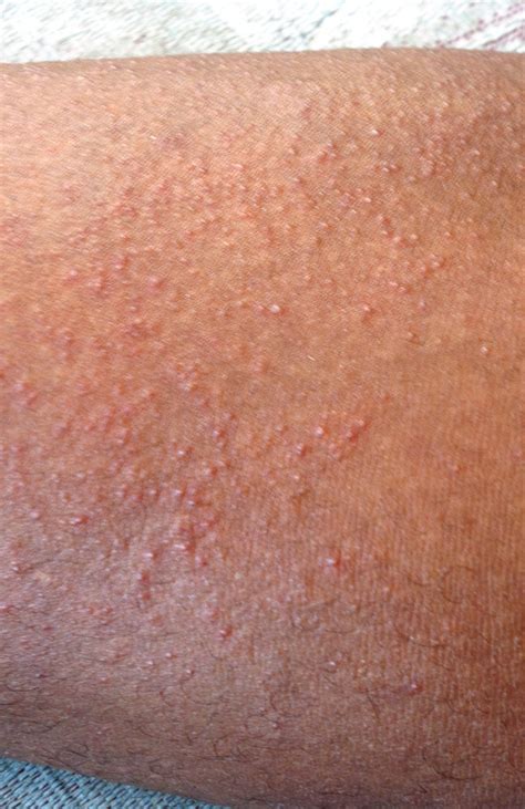 Dealing With Prickly Heat Heat Rash In Hot Climates