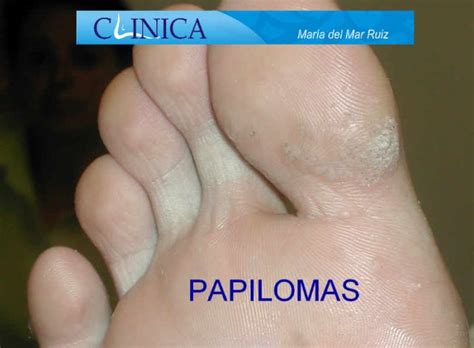 Hiperhidrosis En Los Pies ¿por Qué Se Produce Tratamiento Definitivo