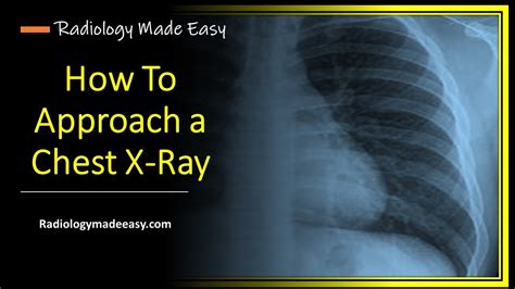 Chest X Ray Interpretation For Medical Students And Doctors Youtube