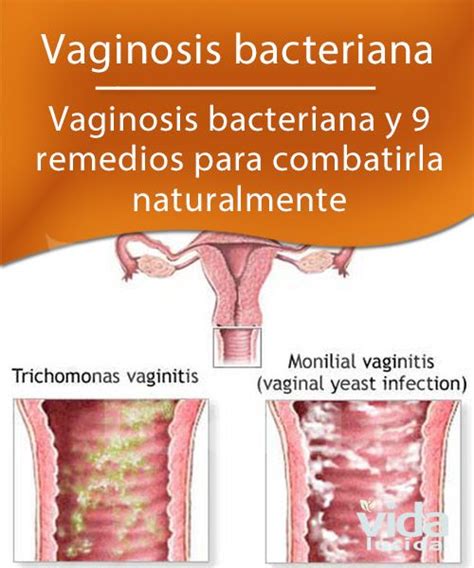 Vaginosis Bacteriana Causas Y Remedios Para Combatirla Infeccion The