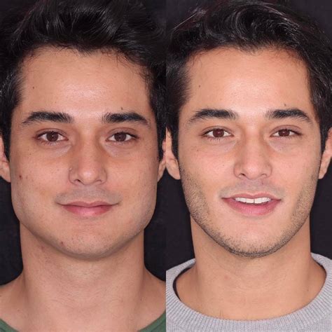 Bichectomia en hombres Fotos del Antes y Después y precio Modaellos com