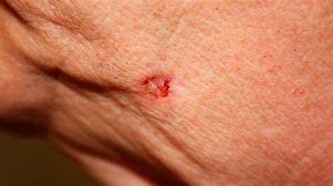 Images Of Basal Cell Carcinoma Pictures Diagnosis And More