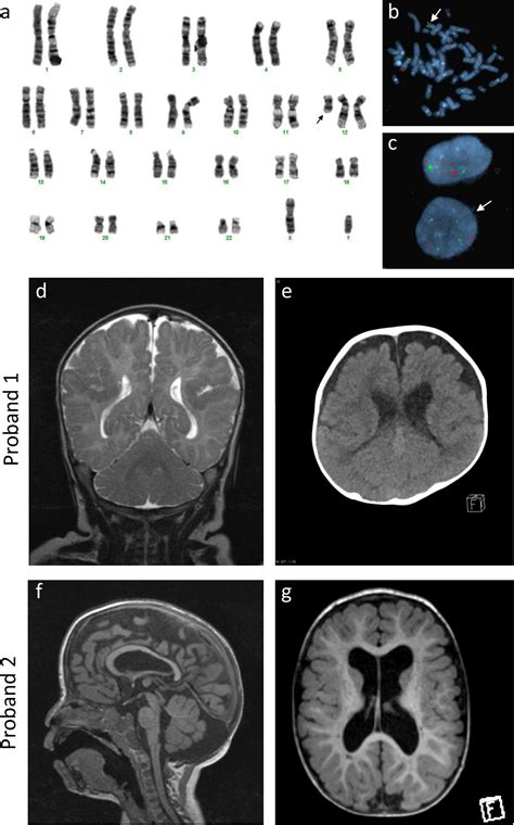 A Review Of Structural Brain Abnormalities In Pallisterkillian