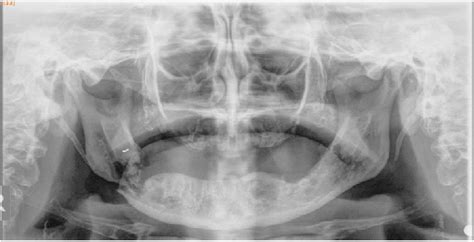 Panoramic Radiograph Showing Worsening Osteolysis At The Site Of