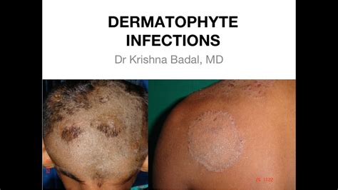 Dermatophyte Infections Of Skin Youtube