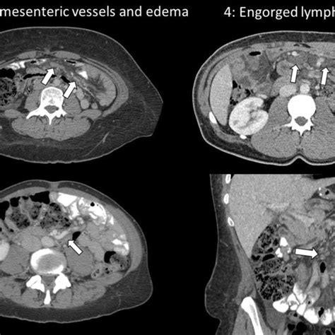 Illustrative Ct Findings In The Diagnosis Of Internal Hernia After