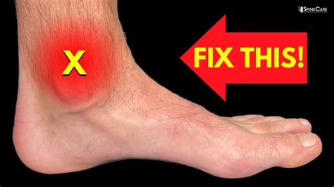 Medial Ankle Pain Tarsal Tunnel Syndrome Sports Injury Physio Vlrengbr