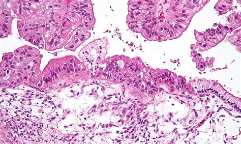 3 Types Of Ovarian Cancer Explained Nih Medlineplus Magazine