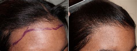 Hair Transplants For Women Photos Miami Fl Patient71518