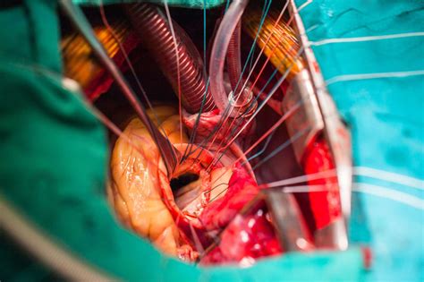 Mitral Valve Repair Minimally Invasive Heart Surgery Vs Sternotomy