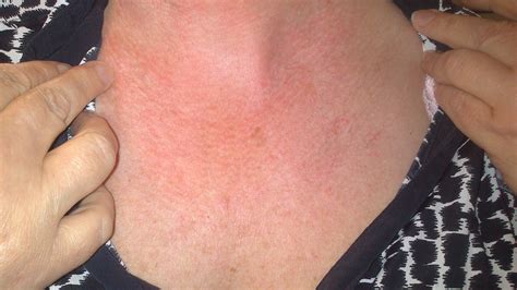 Itchy Rash On Face Neck And Chest Exercises